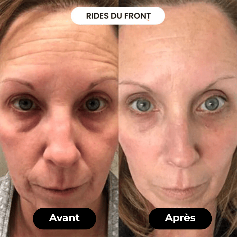 Appareil Anti - âge | LaranaSkin - LARANA