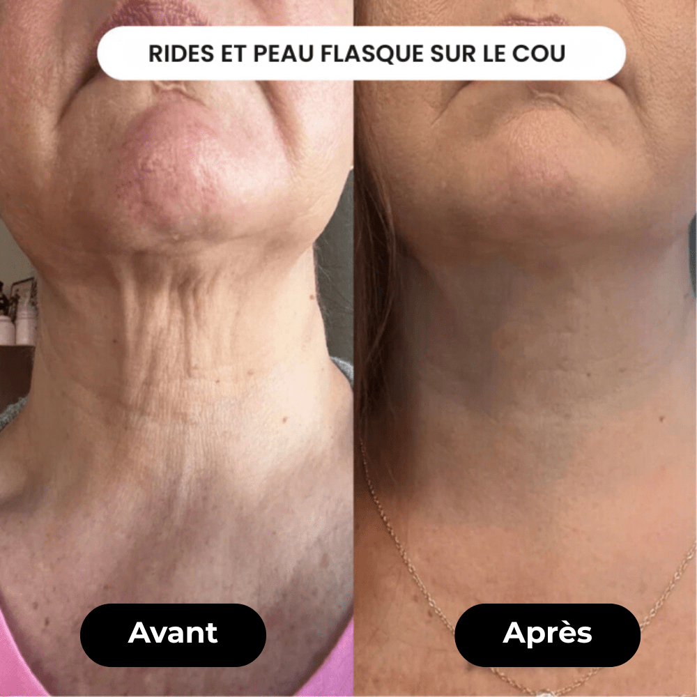 Appareil Anti - âge | LaranaSkin - LARANA