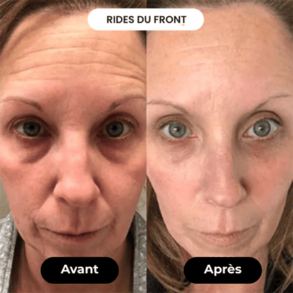 Appareil Anti - âge | LaranaSkin - LARANA